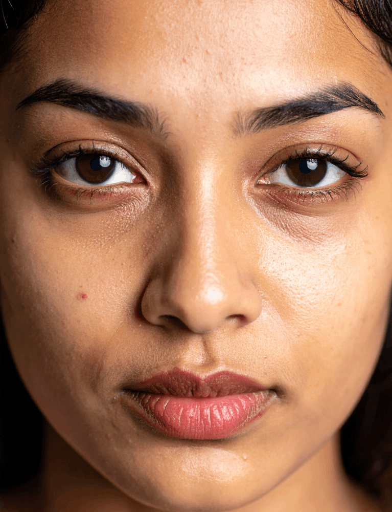 Dermatologist performing dark circle treatment on a patient with under-eye pigmentation at a skin clinic in Chennai.