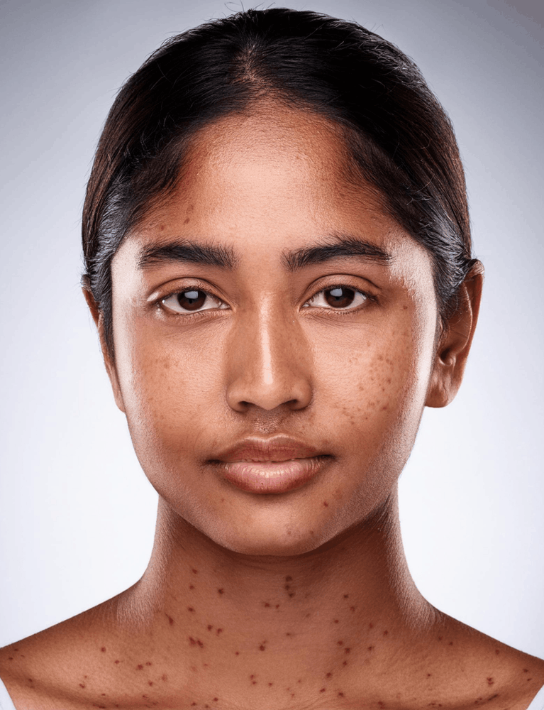 Dermatologist performing dark spots treatment on a patient with facial pigmentation at a skin clinic in Chennai.