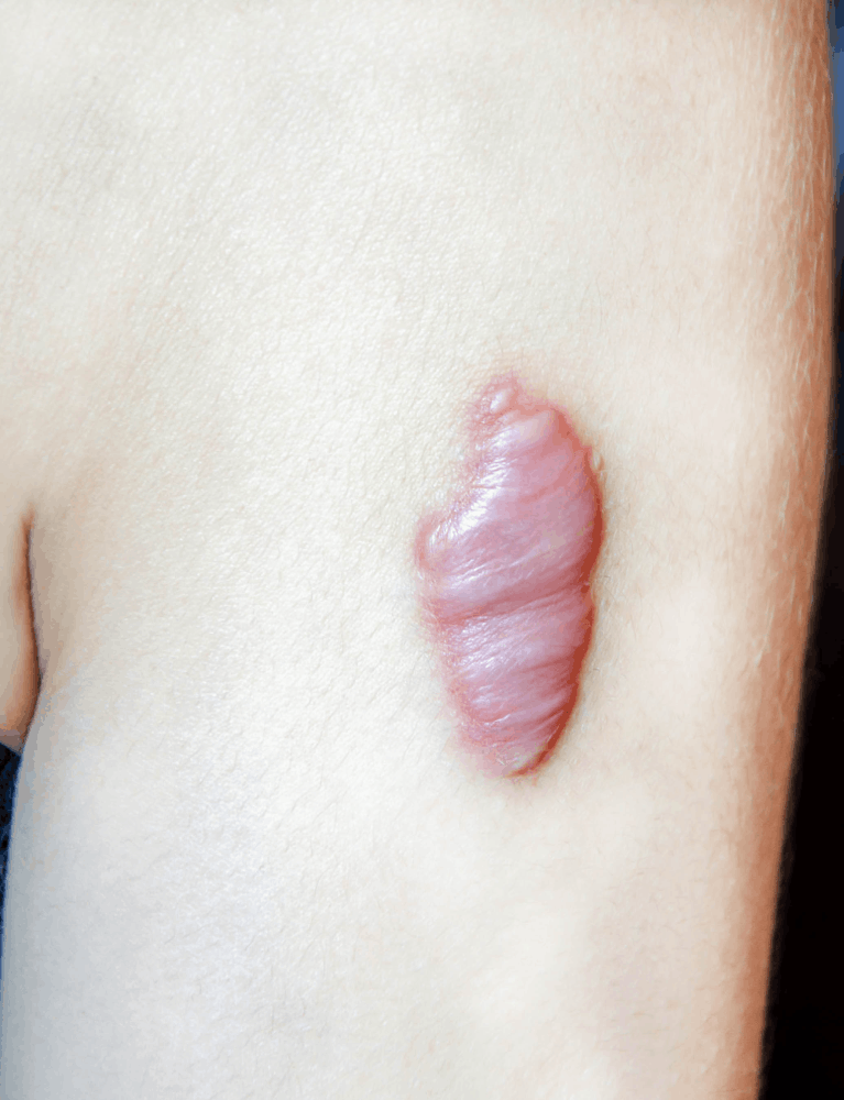 Dermatologist performing keloid removal treatment on a patient at a skin clinic in Chennai.
