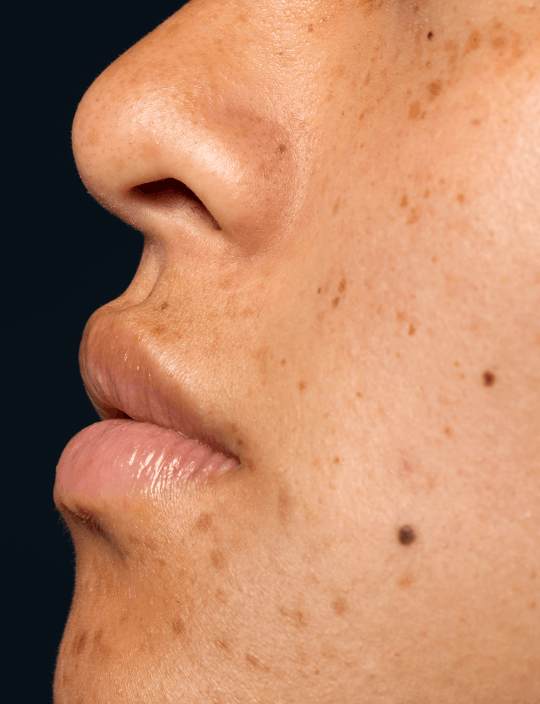 Dermatologist performing milia removal treatment on a patient at a skin clinic in Chennai.