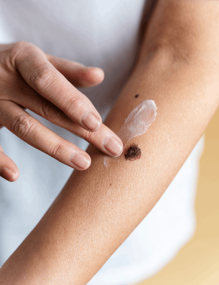 Dermatologist performing mole removal treatment on a patient at a skin clinic in Chennai.