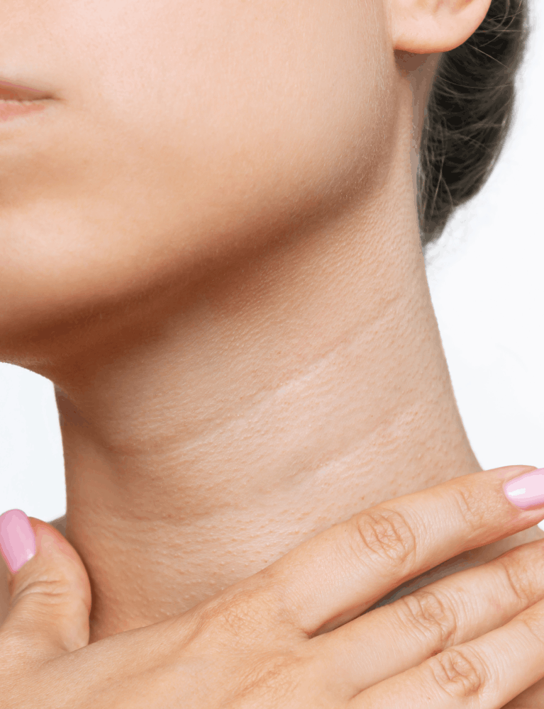 Dermatologist performing neck lines treatment on a patient to reduce wrinkles and improve skin firmness at a skin clinic in Chennai.