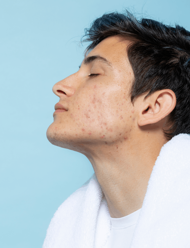 Dermatologist performing open pores treatment on a patient to improve skin texture at a skin clinic in Chennai