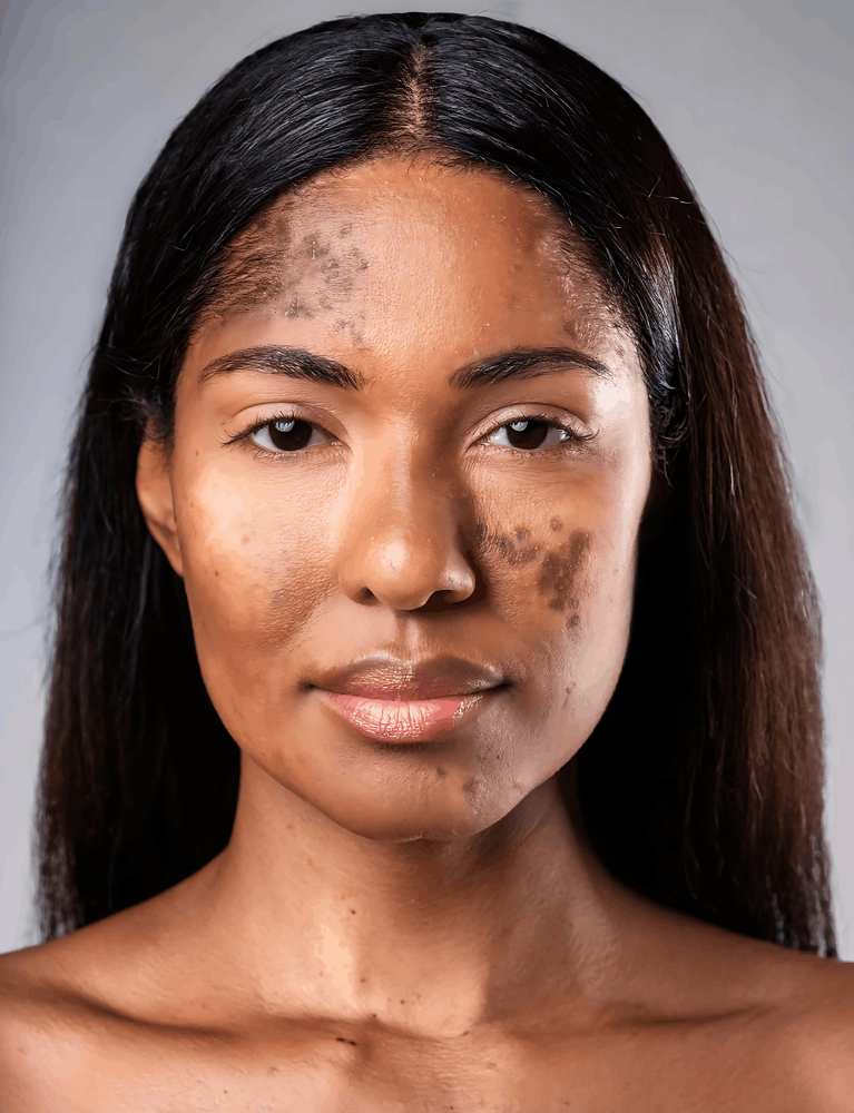 Dermatologist performing pigmentation treatment on a patient with uneven skin tone at a skin clinic in Chennai.