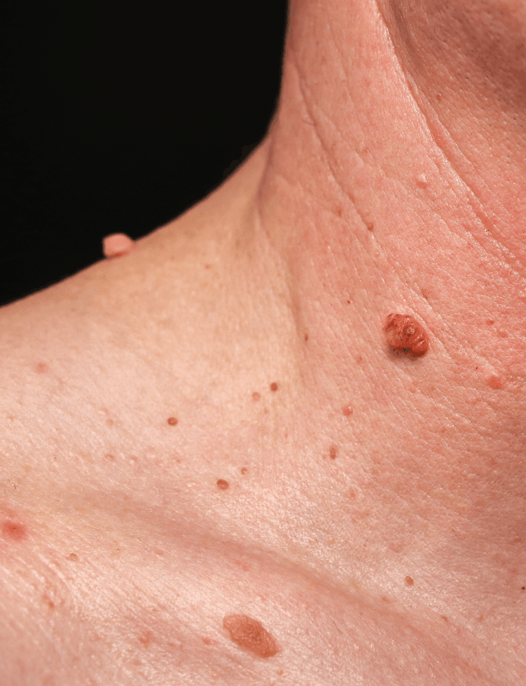 Dermatologist performing skin tag removal treatment on a patient at a skin clinic in Chennai.