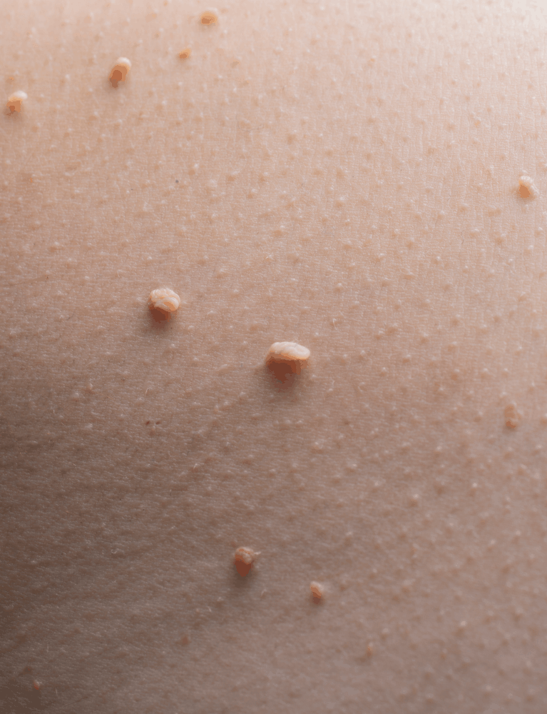 Dermatologist performing wart removal treatment on a patient at a skin clinic in Chennai.