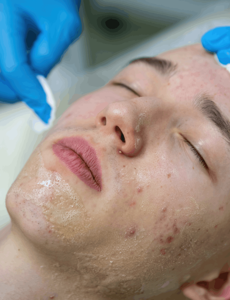 Dermatologist performing an acne control peel treatment on a patient with acne-prone skin at a skin clinic in Chennai.