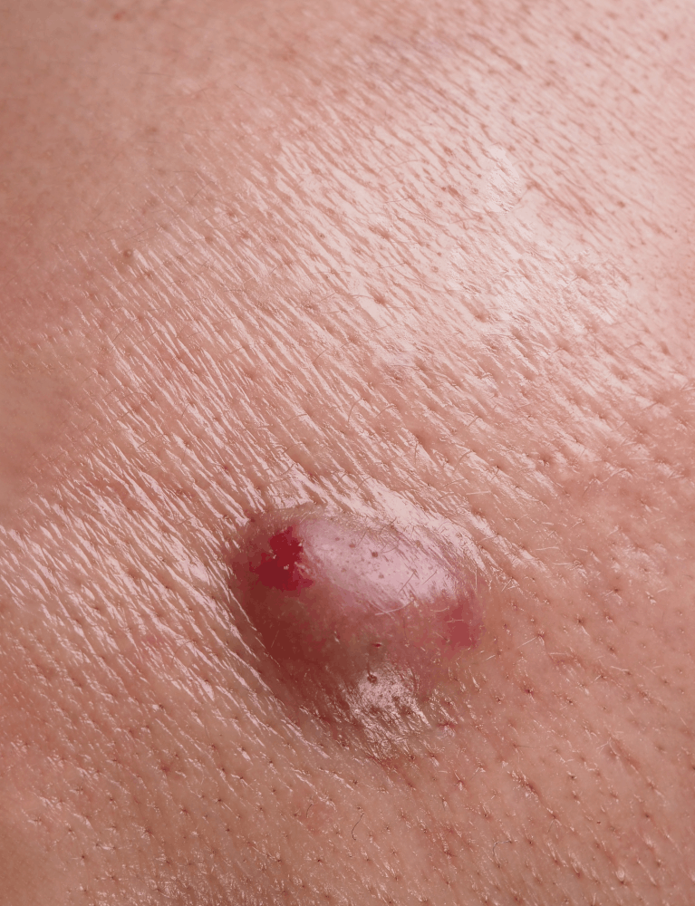Dermatologist performing dermoid cyst removal treatment on a patient at a skin clinic in Chennai.
