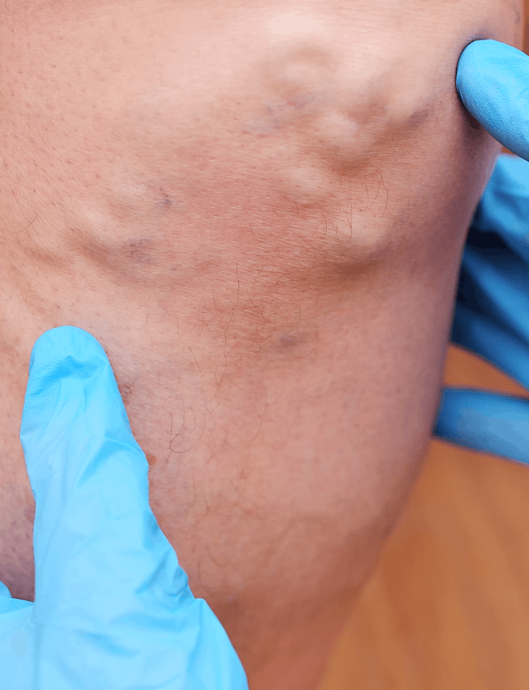 - Dermatologist performing lipoma removal treatment on a patient at a skin clinic in Chennai.