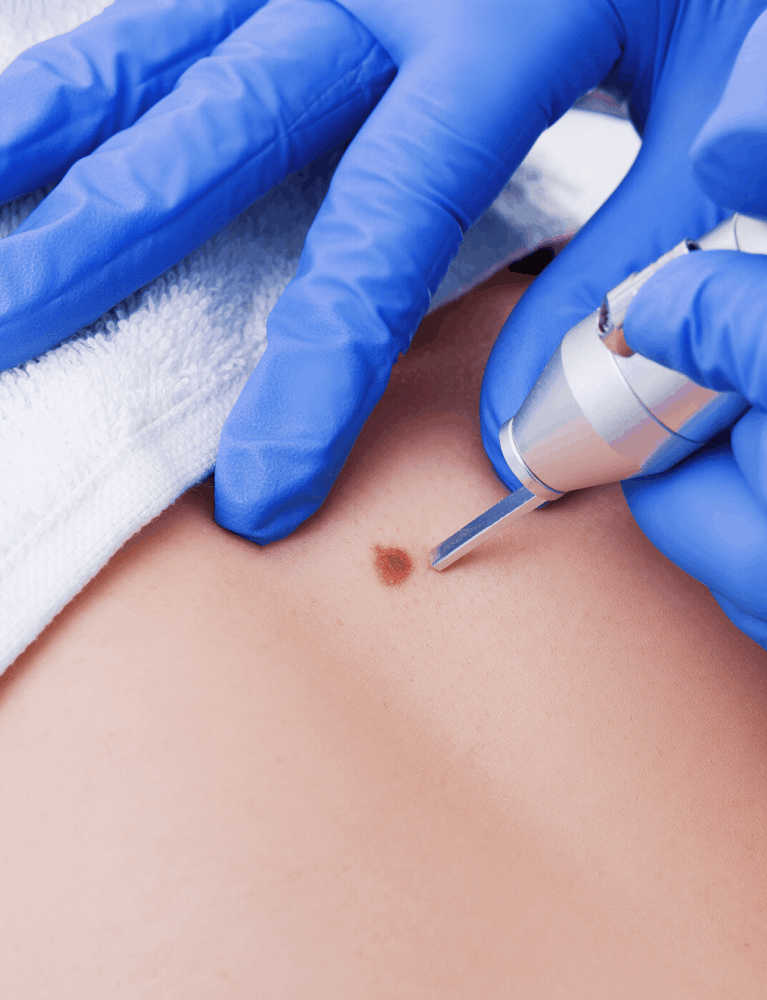 Dermatologist performing sebaceous cyst removal treatment on a patient at a skin clinic in Chennai.