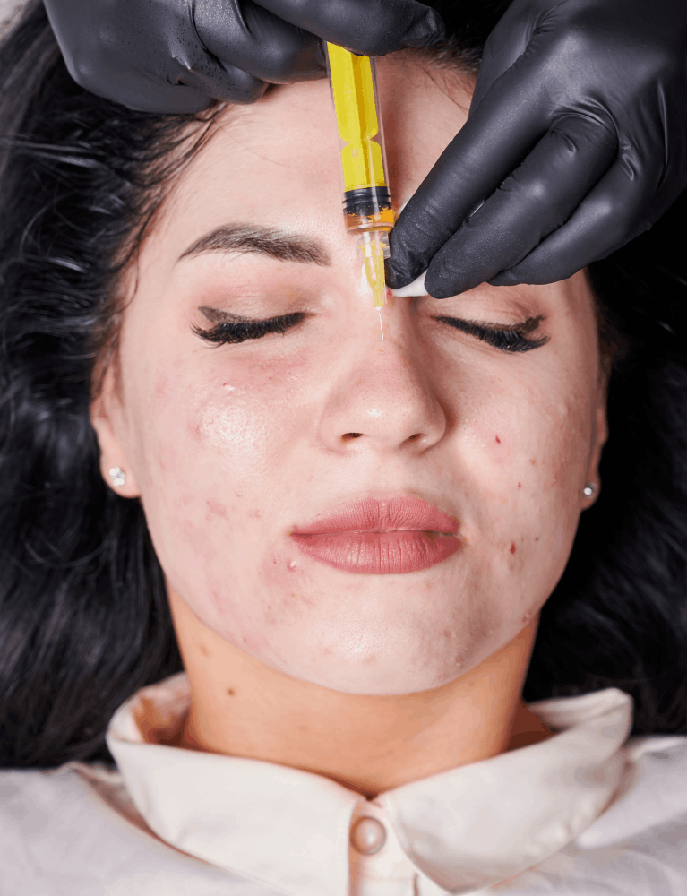 Dermatologist performing PRP acne scar therapy on a patient to improve skin texture at a skin clinic in Chennai.